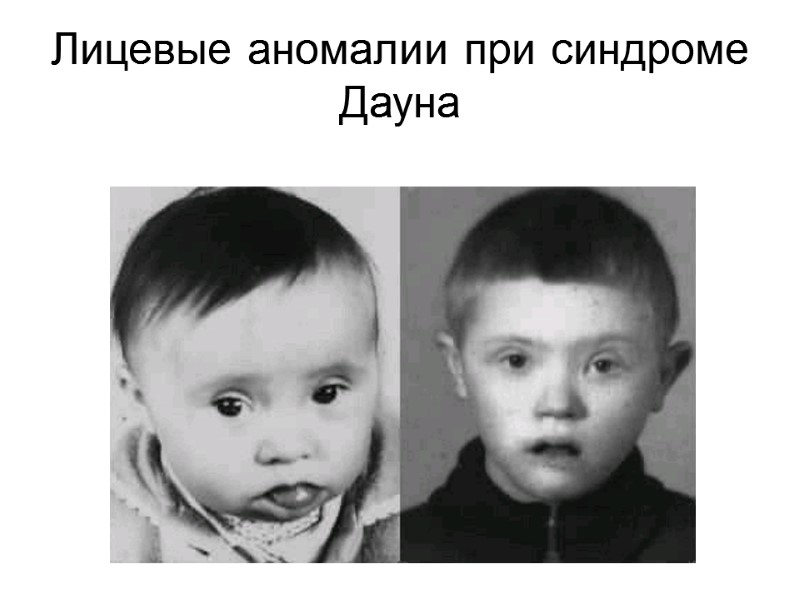 Лицевые аномалии при синдроме Дауна